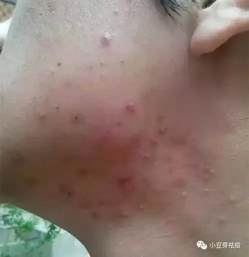 脖子长痘是怎么回事小豆芽老师分享脖子长痘痘的护理秘籍