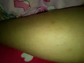 腿上为什么会长一些痘痘