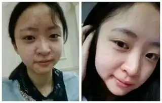 显微镜下一个痘痘200条虫,长痘的脸原来那么脏长痘必看.......