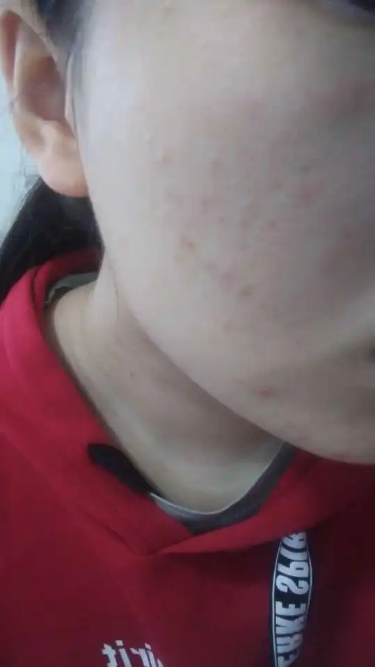 我是大学女生,油皮痘肌敏感肌,有什么牌子的护肤品推荐