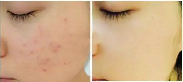 男生长痘是因为没女朋友吗今日头条
