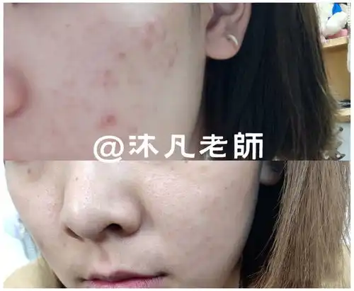 脓包型痤疮可以吃丹参酮吗,脓包型痤疮看医生没用