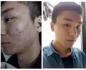 慎入显微镜下的痘痘竟然是这个样子的