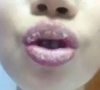 因为这个有口难言的病,平湖一女孩差点找不到男朋友...