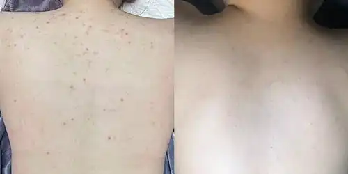 前胸后背和脖子都长了这种痘痘怎么办而且很多看起来整个背都是