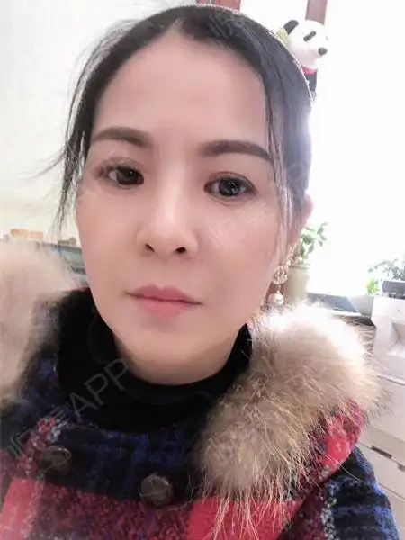 玻尿酸吸收的速度是有一些差异的,注射部位与表情活跃...去静态皱纹悦美整形