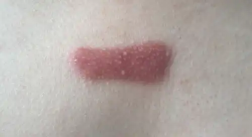 疤痕疙瘩到底怎么治能不能治好自己胸前长了一个,增长速度越来越快,应该是08年胸前偶有长痘痘留下的