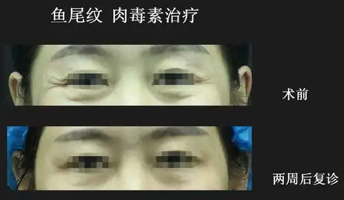 时尚界的宠儿肉毒毒素为什么可以扛起岁月的刀
