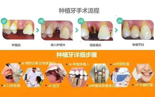 一颗种植牙价格为什么这么高比普通假牙好在哪