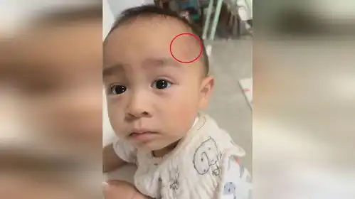 宝宝额头被蚊子叮了个大包,委屈表情包