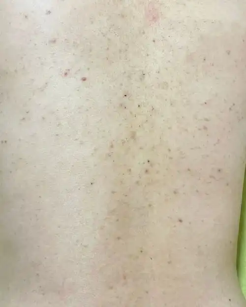 女生背后长痘痘该如何解决