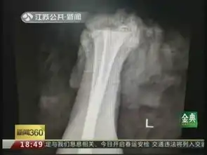 江苏高三男生为戒网瘾自剁左手断手被找到后接上