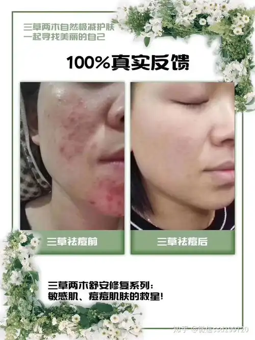 熬夜毛孔粗大还长痘怎么办