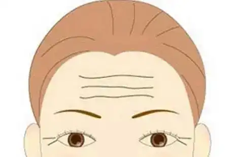 抬头纹显老那就去掉啊