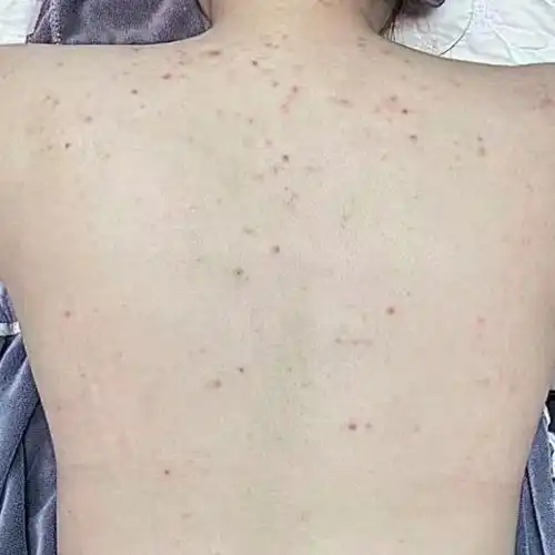前胸后背和脖子都长了这种痘痘怎么办而且很多看起来整个背都是
