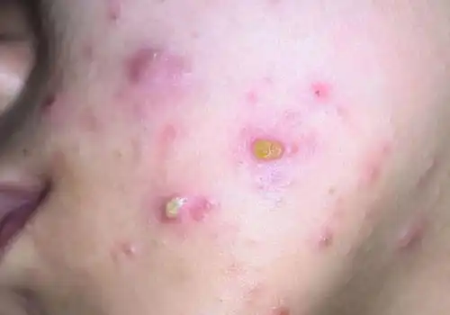 中医老偏方教你清除痘痘,长在不同位置的痘痘要不同对待