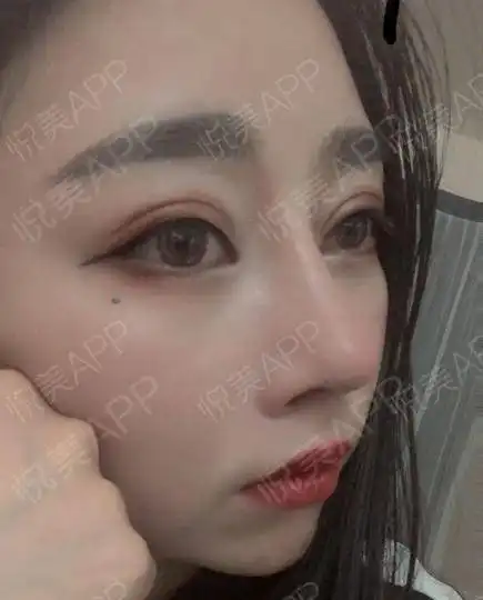 鼻子已经是48天了,我现在是化身成一个毫无表情的的自...垫鼻尖悦美整形