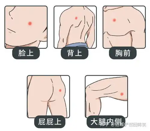 女生下面也会长痘痘,是怎么回事原因大多逃不开这3个