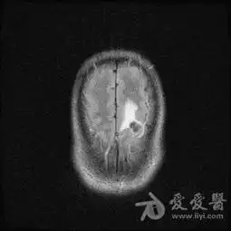 男性患者,55岁,头晕头痛4个月,近日加重医学影像学讨论版爱爱医医学论坛