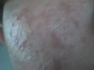 脓包型闭锁性痘痘还有大片的发炎,脸上长出了又长又黑又多的汗毛