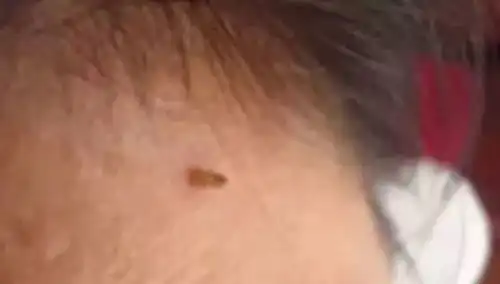 这里长肉粒可不是痘痘那么简单快看看你脖子上有吗