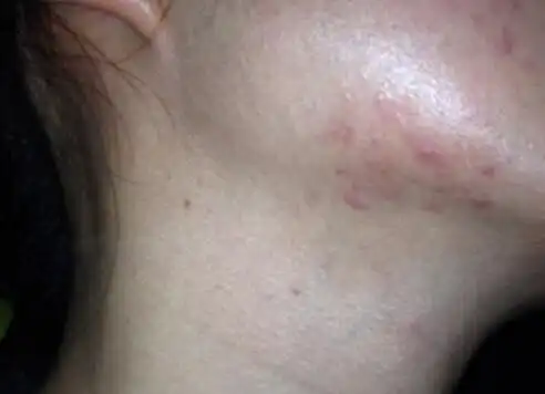 科痘透露,下巴经常出现大量痘痘主要和这几点有关