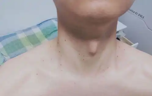 脖子上长的小肉粒是什么可以直接揪掉吗如何治疗一文全说清