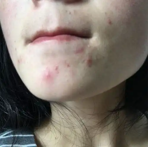 下巴出现这样的小痘痘千万要注意了,你知道是为什么吗