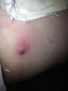 我的大腿上长了个痘痘,不知是啥,发现时已经破了,请问是什么病啊