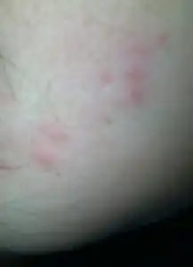 我屁股长了一些痘痘,每天洗澡的时候特别痒,好长时间了