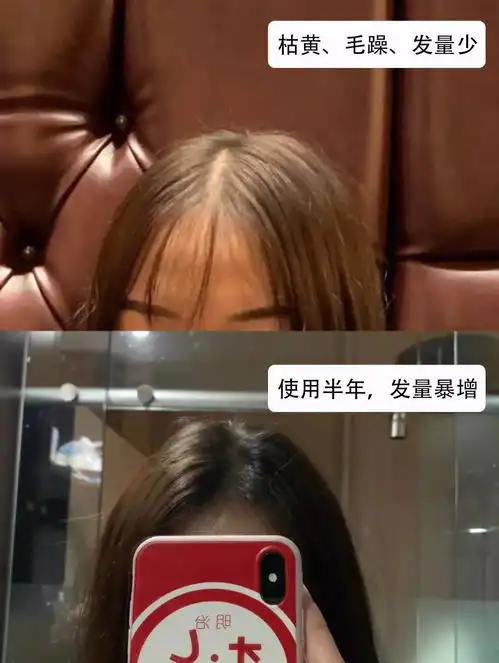 你的头发一根都不许掉用它,发量暴增,去屑止痒,还你浓密秀发头皮