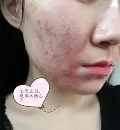显微镜下一个痘痘200条虫,长痘的脸原来那么脏长痘必看......