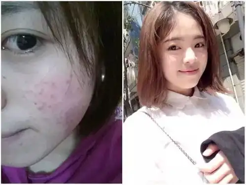 本文献给,满脸痘痘痘痕痘印的你...真是想不到...