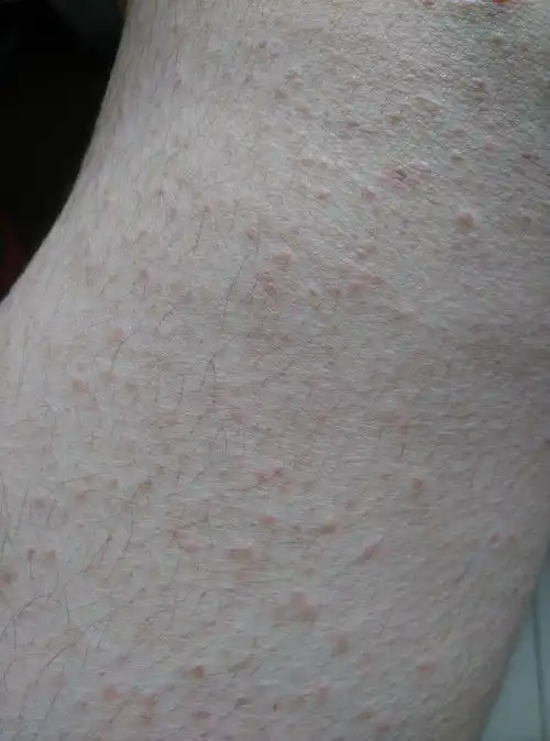 腿上不知道长的什么痘痘都长在毛孔一挤就是白色的东西求专家解答谢谢