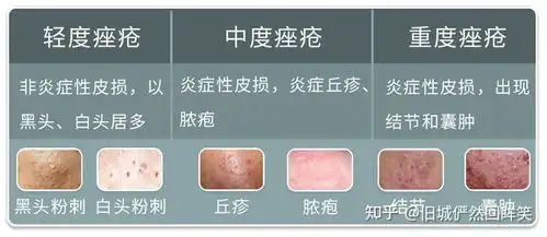 女生下面也会长痘痘,是怎么回事原因大多逃不开这3个