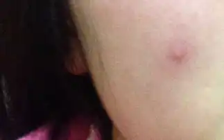 脸上长了一颗脓包痘痘可以挤吗之前这个地方长了一个,让我挤掉了,红红的印子还没下去就又在这个地方长