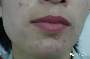 一定没有人告诉你,这样的痘痘必须要挤掉