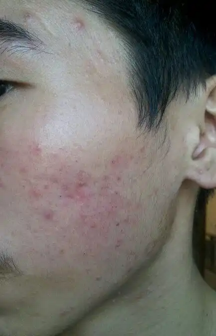 我脖子白白的长的是什么还有痘痘和痘印严重嘛怎么办对了黑头怎么弄挤了
