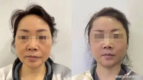 面部皱纹能通过组织复位手术改善吗袁强博士眼周除皱术动态纹