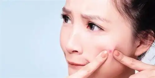 科瑞缇长痘痘,千万不能盲目使用产品