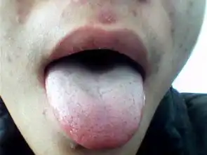 这是青春痘吗怎么治