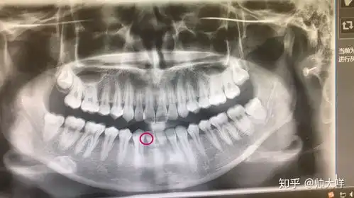 做正畸,医生说我下牙先天缺一颗牙