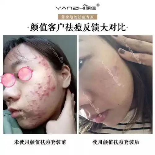 一个痘痘200条虫,长痘痘的脸原来那么脏,你有痘你先看.