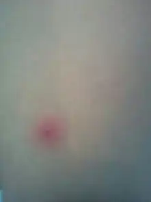 大腿上长了这个痘痘一碰就疼是怎么了