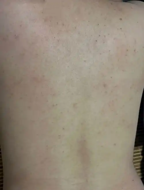 女生背后长痘痘该如何解决