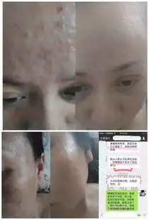 知乎显微镜下的痘痘,一个痘痘200条虫长痘必看.......