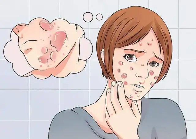 痘花妹们的疑惑我一直长痘是因为内分泌紊乱