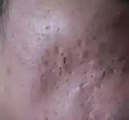 长期长痘不管,半年后居然变成了这个样子