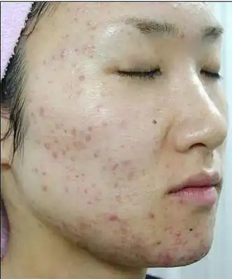 脸上长痘吃什么水果好,什么水果能祛痘