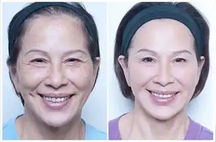 女人要命好,自体细胞除皱少不了